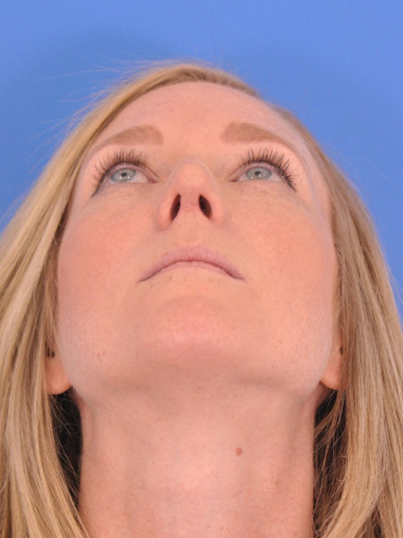 Rhinoplasty Before & After Gallery - Patient 166724988 - Image 12