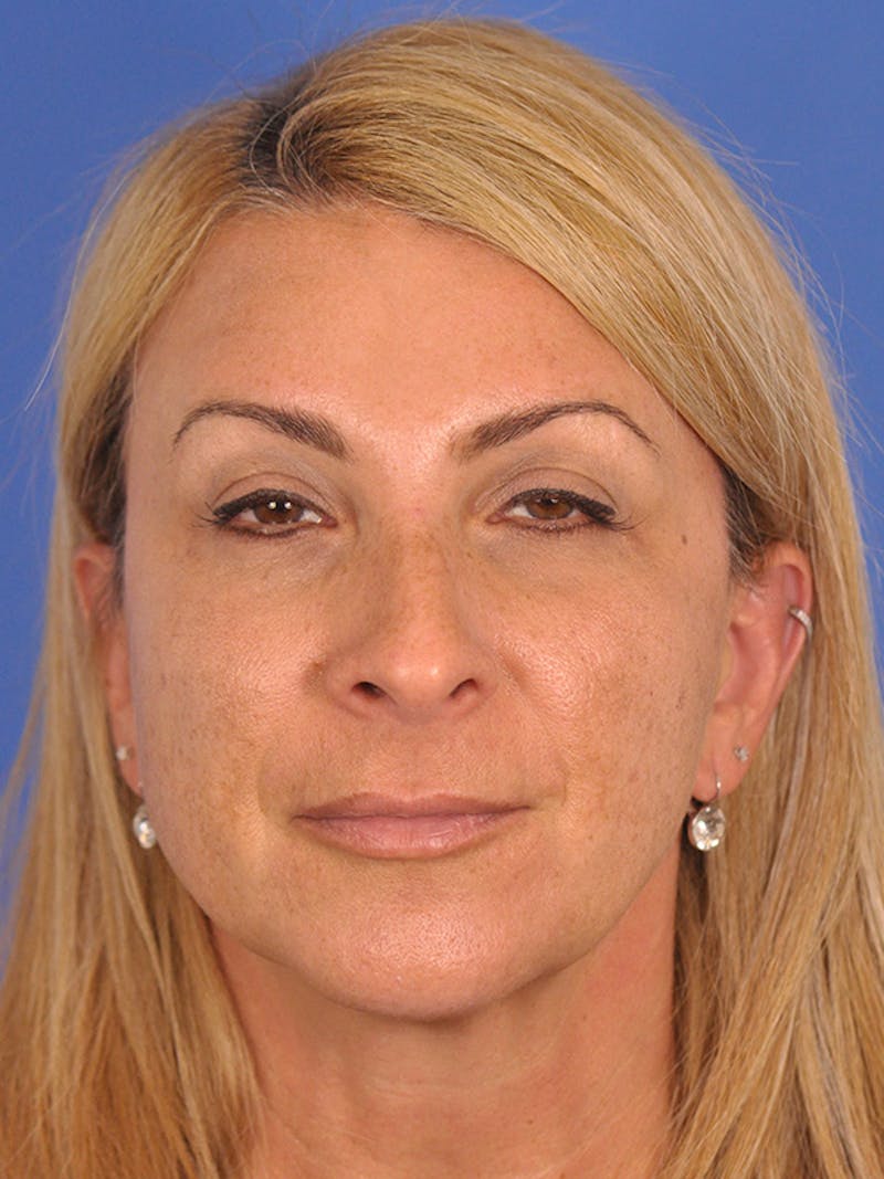 Rhinoplasty Before & After Gallery - Patient 166724987 - Image 3