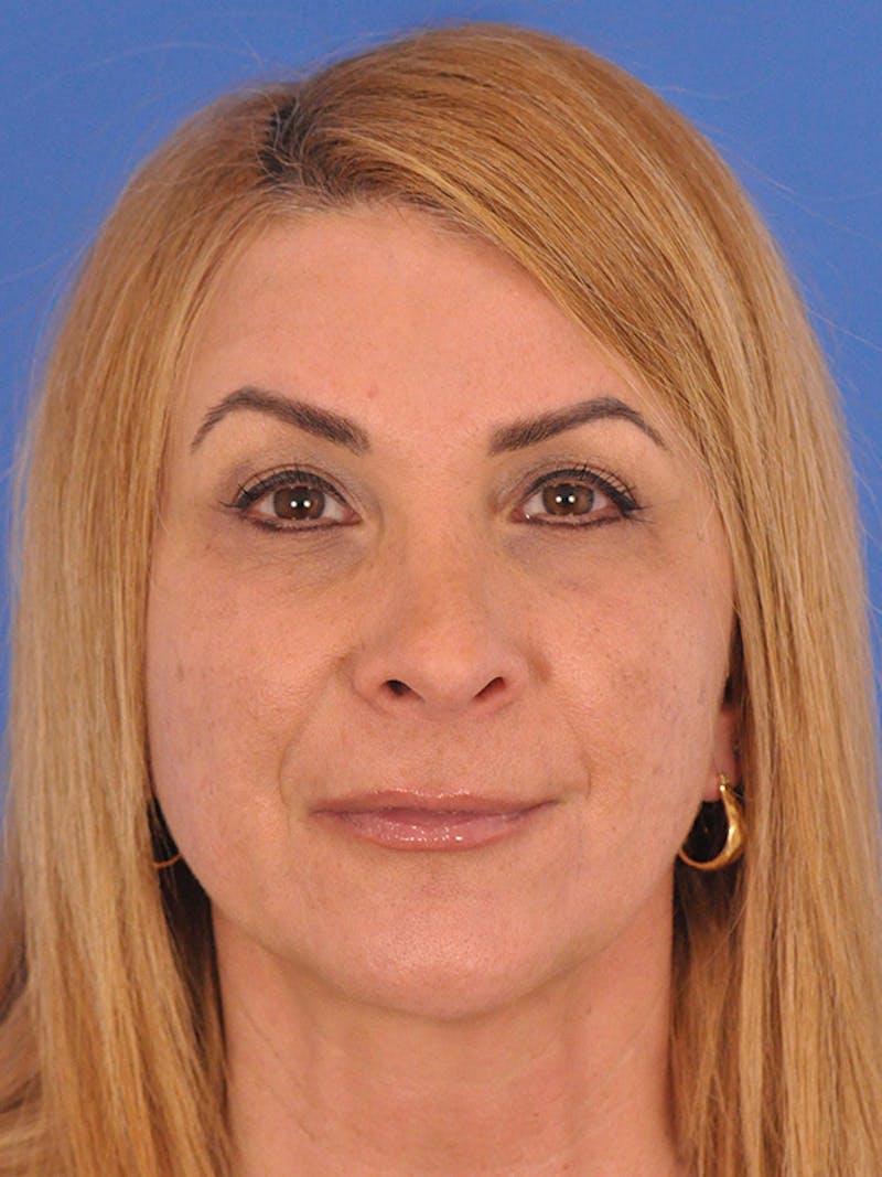 Rhinoplasty Before & After Gallery - Patient 166724987 - Image 4