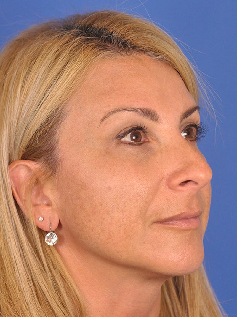 Rhinoplasty Before & After Gallery - Patient 166724987 - Image 5