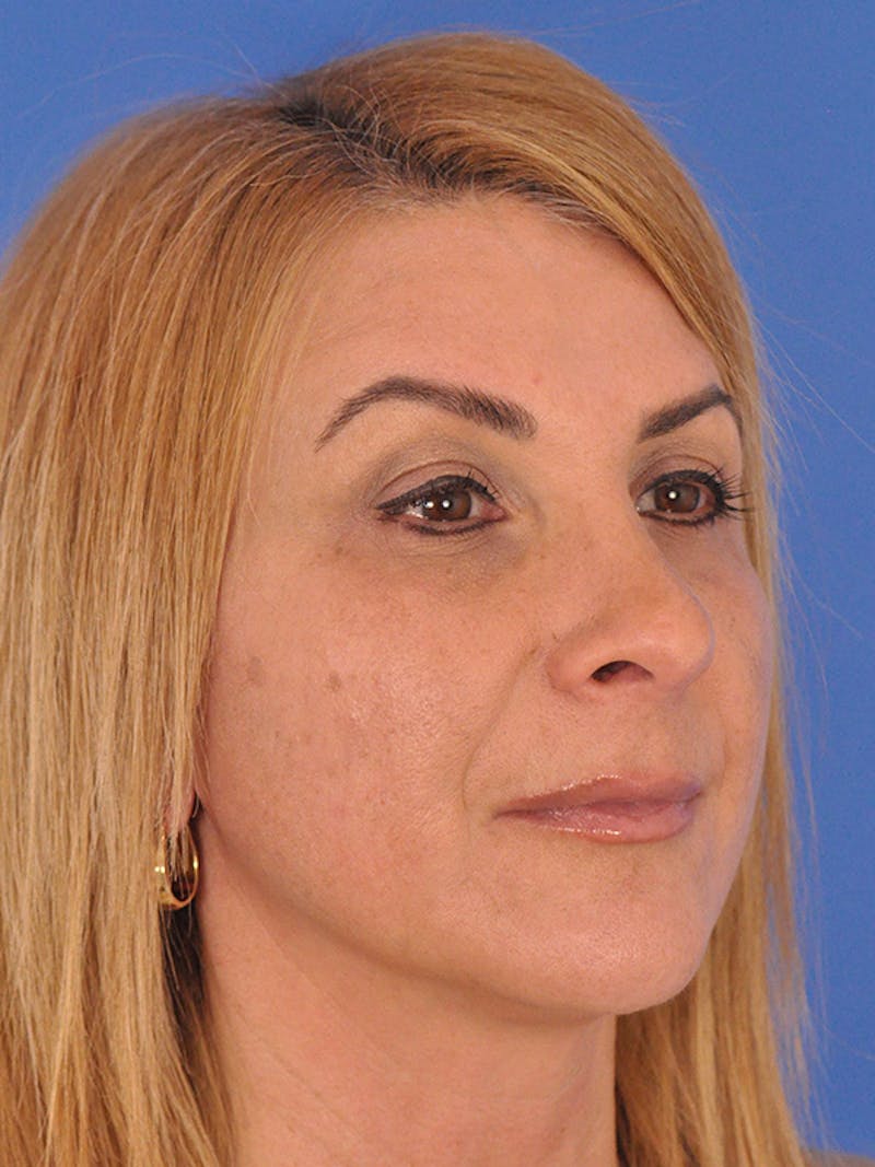 Rhinoplasty Before & After Gallery - Patient 166724987 - Image 6