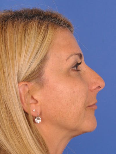 Rhinoplasty Before & After Gallery - Patient 166724987 - Image 1