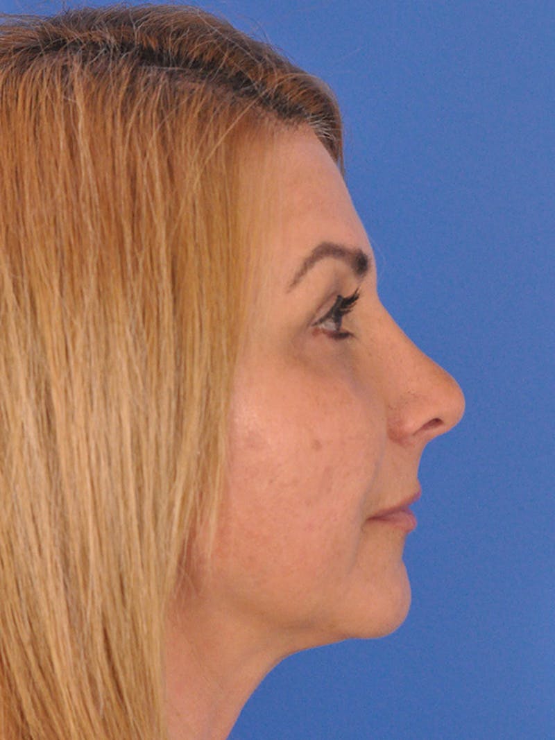 Rhinoplasty Before & After Gallery - Patient 166724987 - Image 2