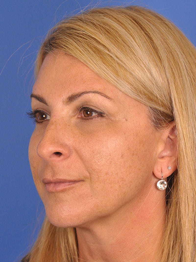 Rhinoplasty Before & After Gallery - Patient 166724987 - Image 7