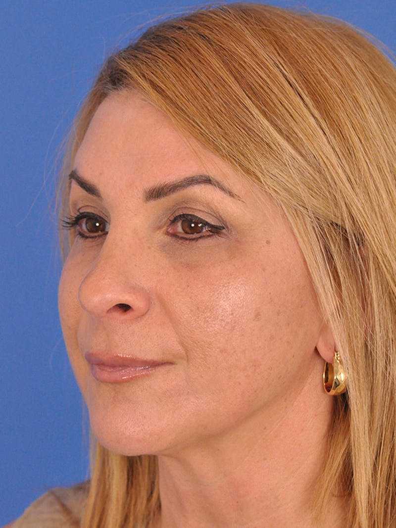 Rhinoplasty Before & After Gallery - Patient 166724987 - Image 8