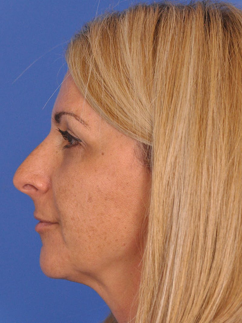 Rhinoplasty Before & After Gallery - Patient 166724987 - Image 9