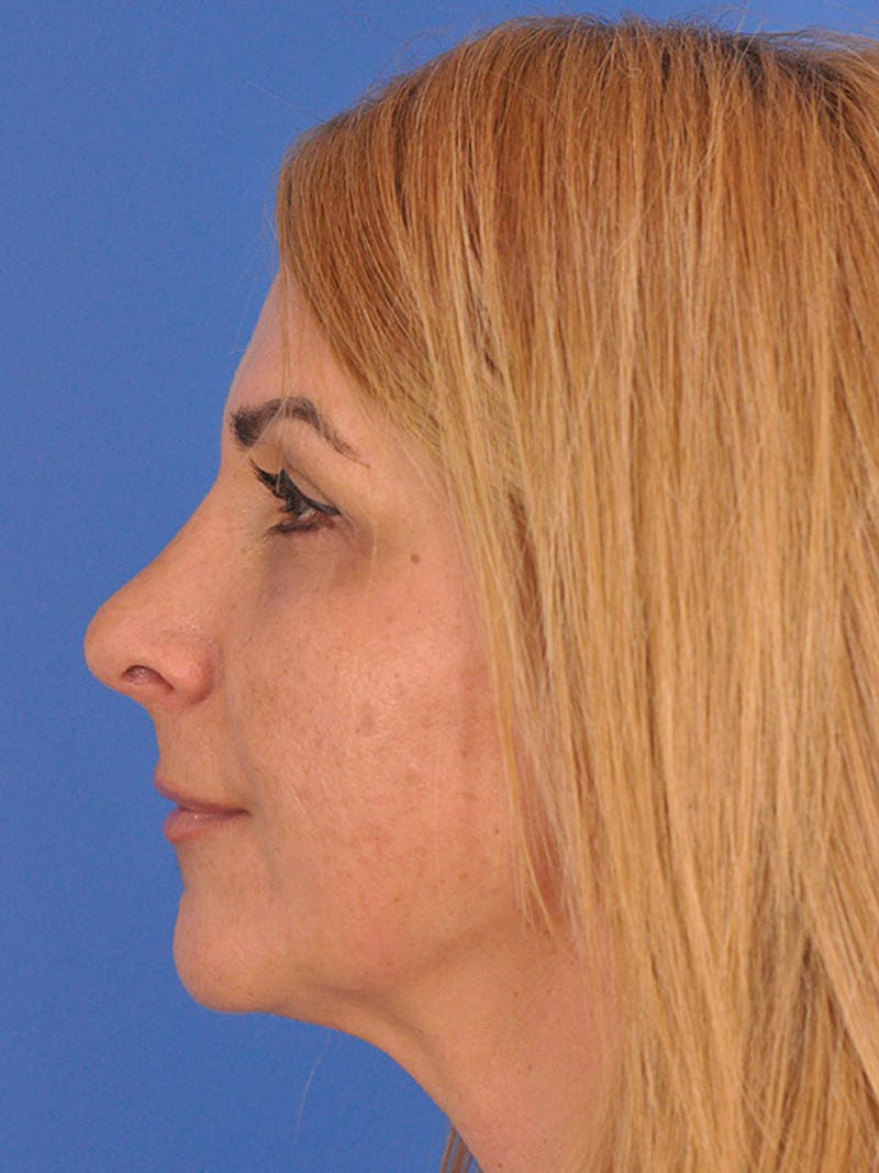 Rhinoplasty Before & After Gallery - Patient 166724987 - Image 10