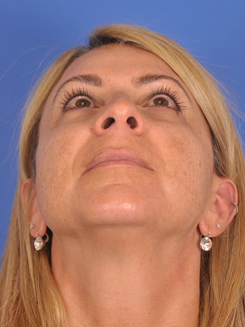 Rhinoplasty Before & After Gallery - Patient 166724987 - Image 11