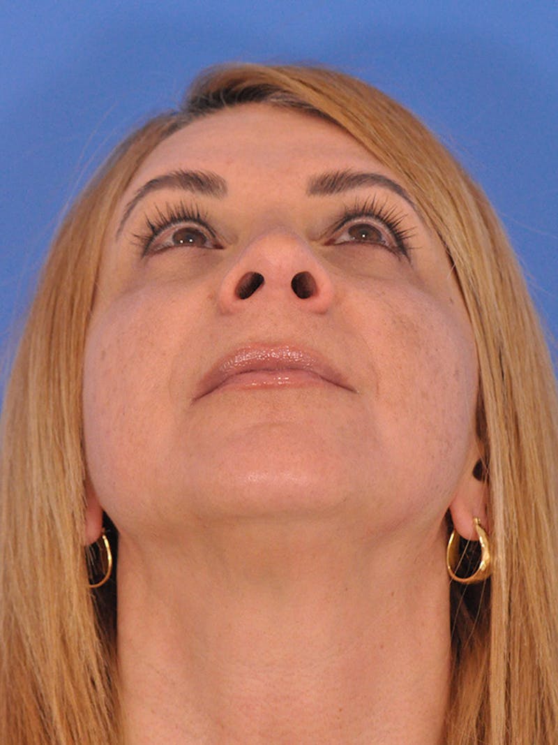 Rhinoplasty Before & After Gallery - Patient 166724987 - Image 12