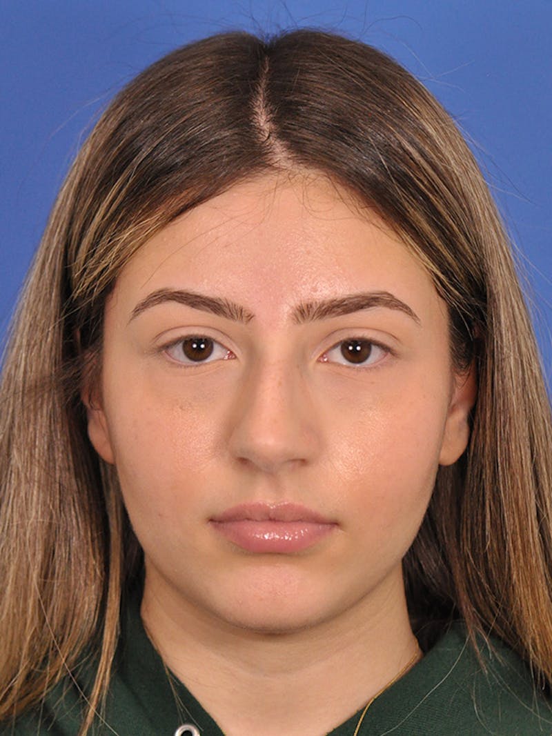 Rhinoplasty Before & After Gallery - Patient 166725000 - Image 3