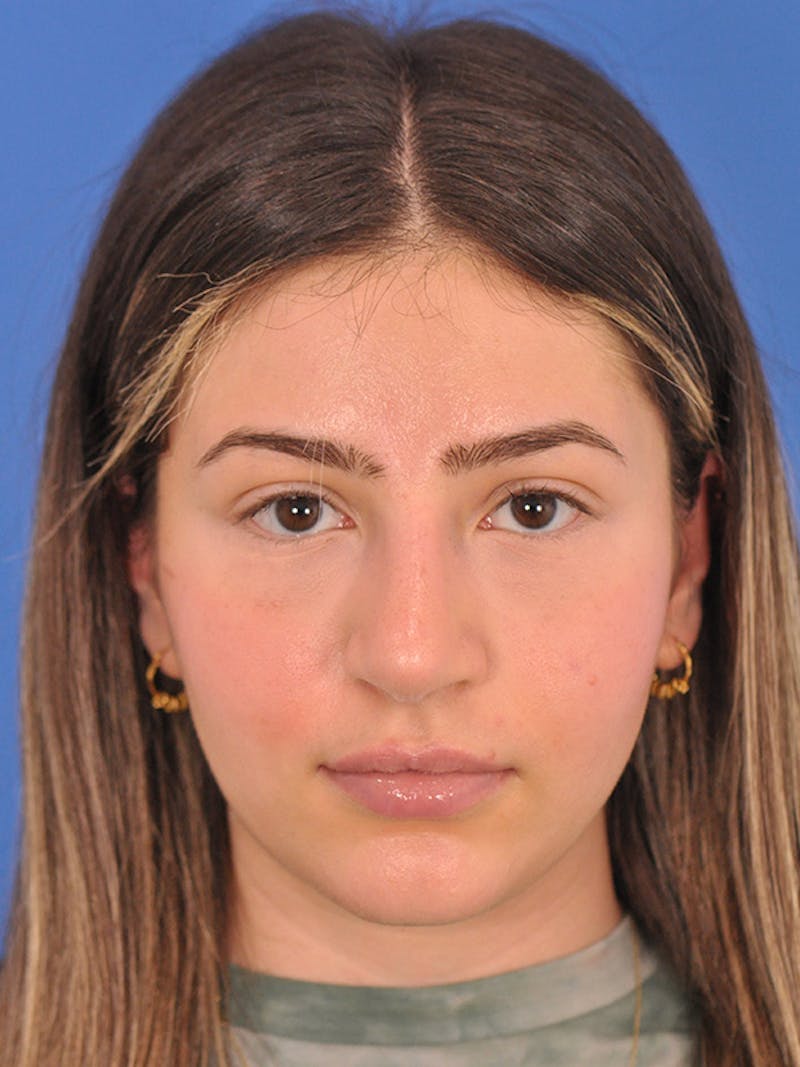 Rhinoplasty Before & After Gallery - Patient 166725000 - Image 4