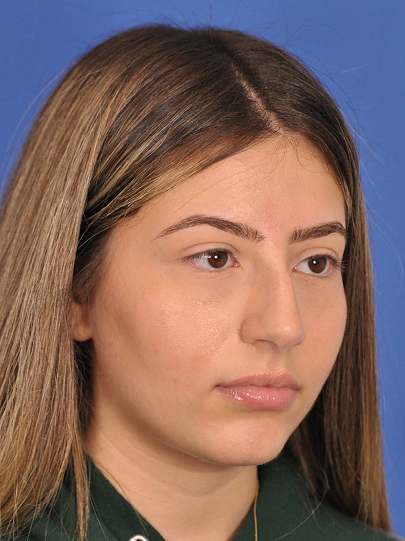 Rhinoplasty Before & After Gallery - Patient 166725000 - Image 5