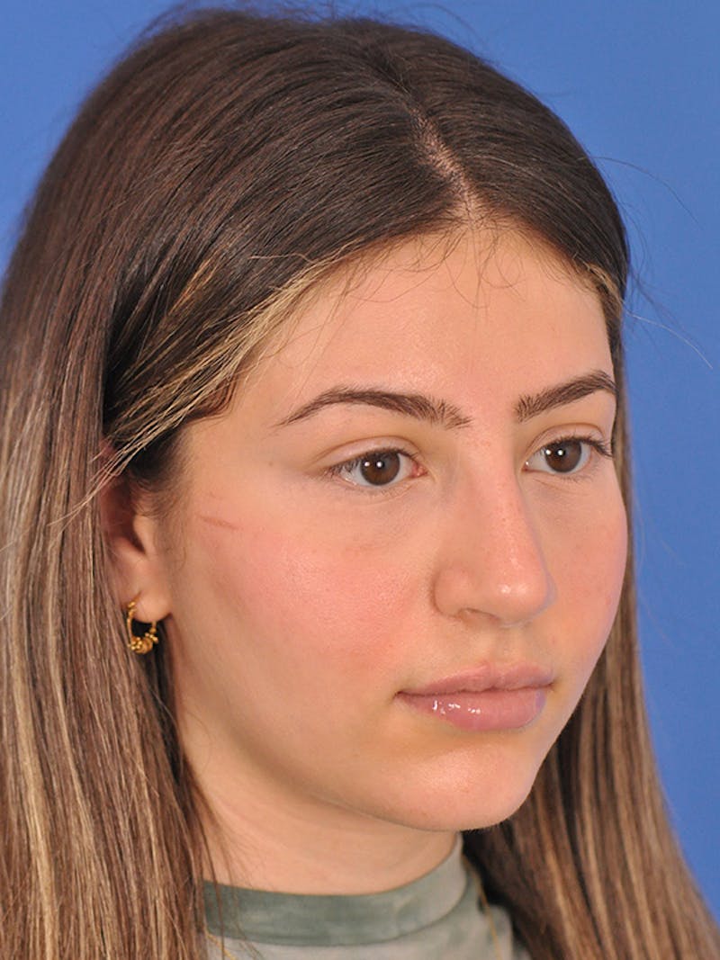 Rhinoplasty Before & After Gallery - Patient 166725000 - Image 6