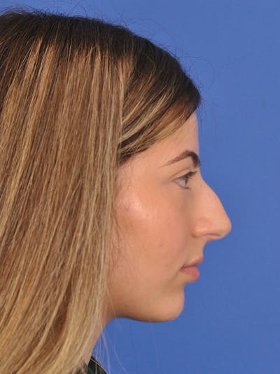 Rhinoplasty Before & After Gallery - Patient 166725000 - Image 1