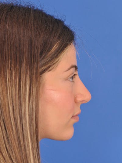 Rhinoplasty Before & After Gallery - Patient 166725000 - Image 2