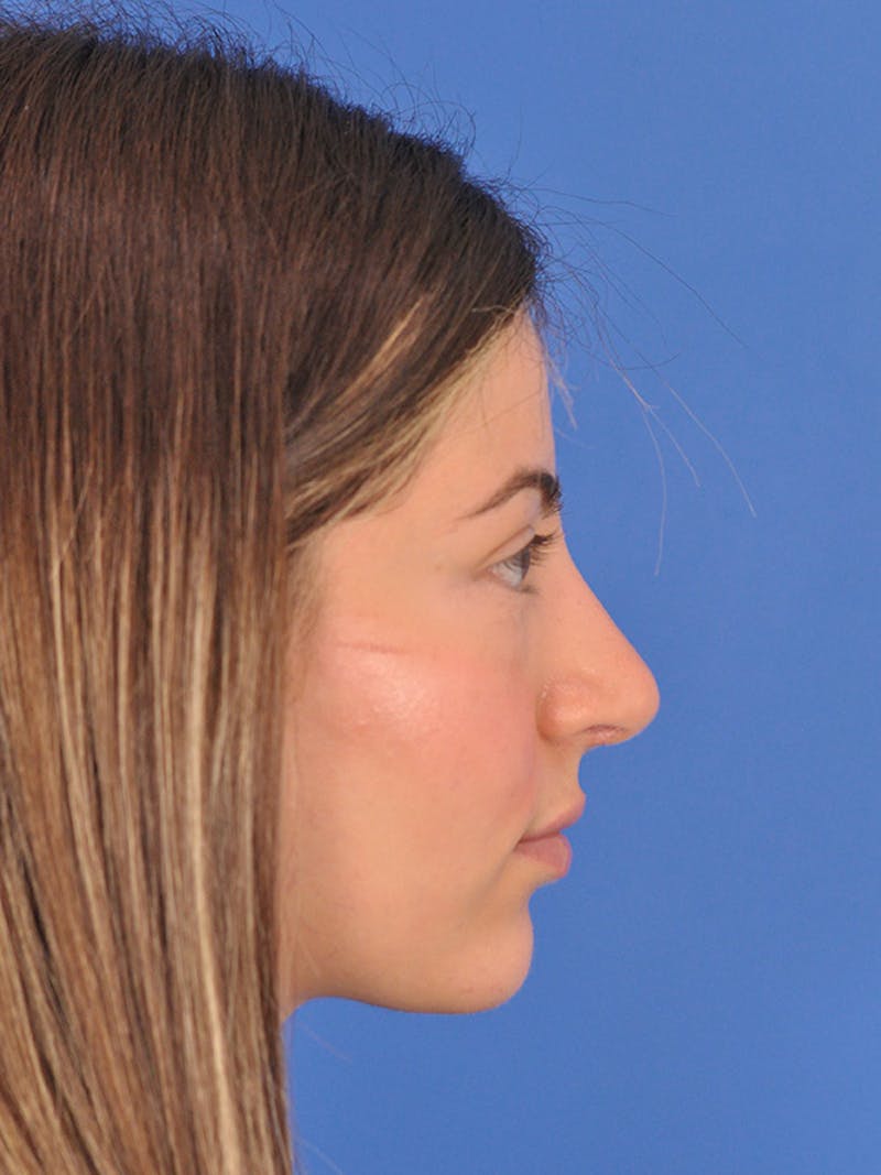 Rhinoplasty Before & After Gallery - Patient 166725000 - Image 2