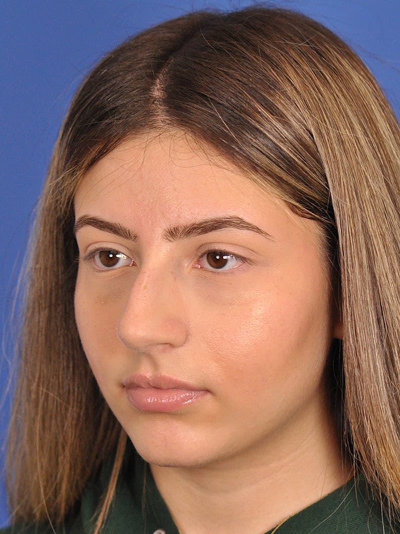 Rhinoplasty Before & After Gallery - Patient 166725000 - Image 7