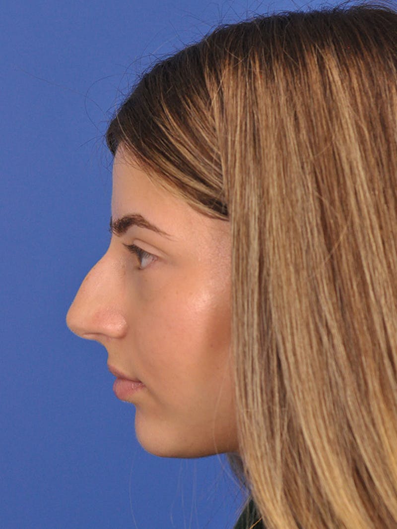 Rhinoplasty Before & After Gallery - Patient 166725000 - Image 9