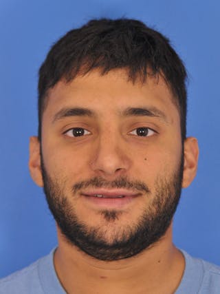 Rhinoplasty Before & After Gallery - Patient 166725714 - Image 4