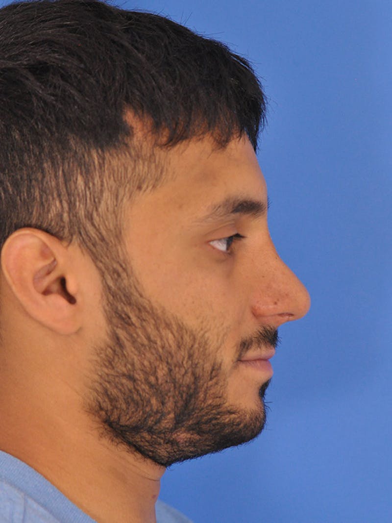 Rhinoplasty Before & After Gallery - Patient 166725714 - Image 2
