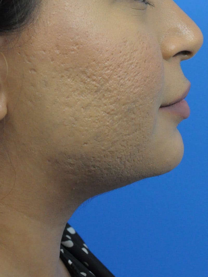 CO2RE Laser Before & After Gallery - Patient 180861986 - Image 1