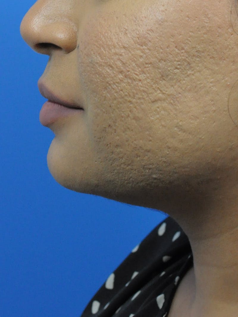 CO2RE Laser Before & After Gallery - Patient 180861986 - Image 3