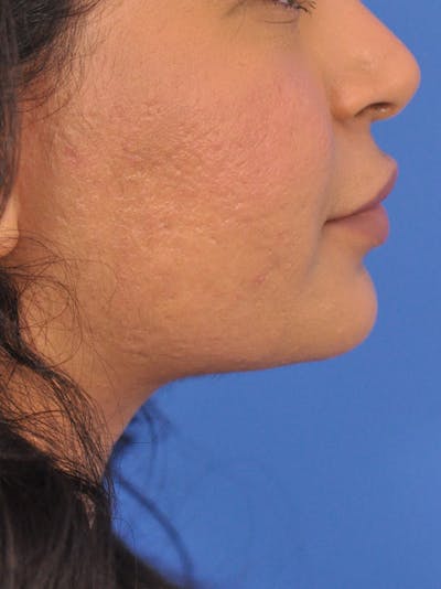 CO2RE Laser Before & After Gallery - Patient 180861986 - Image 2