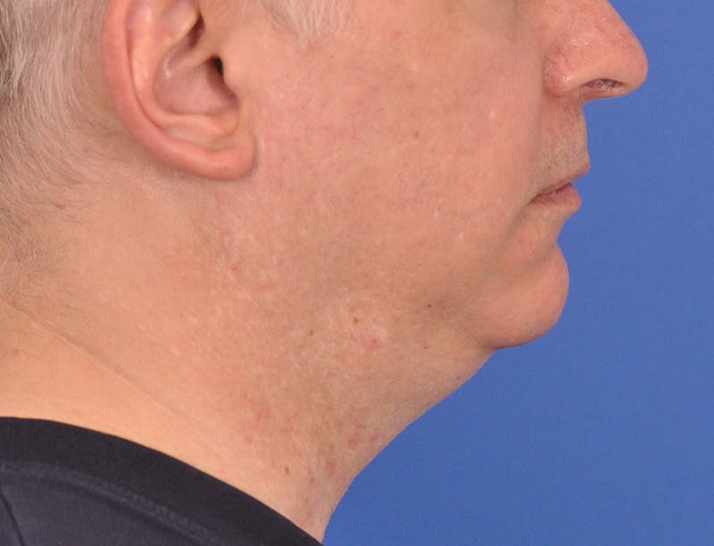 Neck Lift Before & After Gallery - Patient 180861992 - Image 1