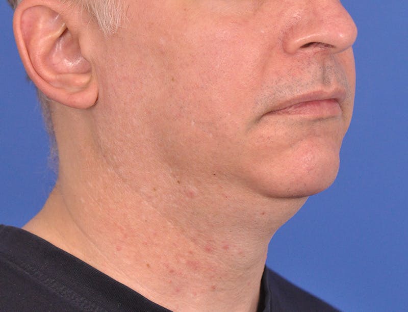 Neck Lift Before & After Gallery - Patient 180861992 - Image 3