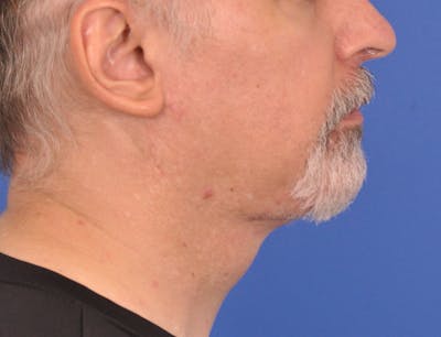 Neck Lift Before & After Gallery - Patient 180861992 - Image 2