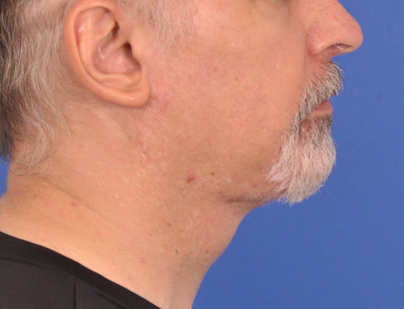Neck Lift Before & After Gallery - Patient 180861992 - Image 2