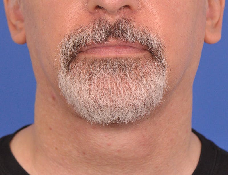 Neck Lift Before & After Gallery - Patient 180861992 - Image 6