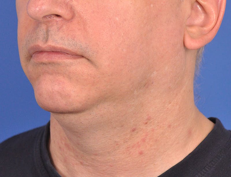 Neck Lift Before & After Gallery - Patient 180861992 - Image 7