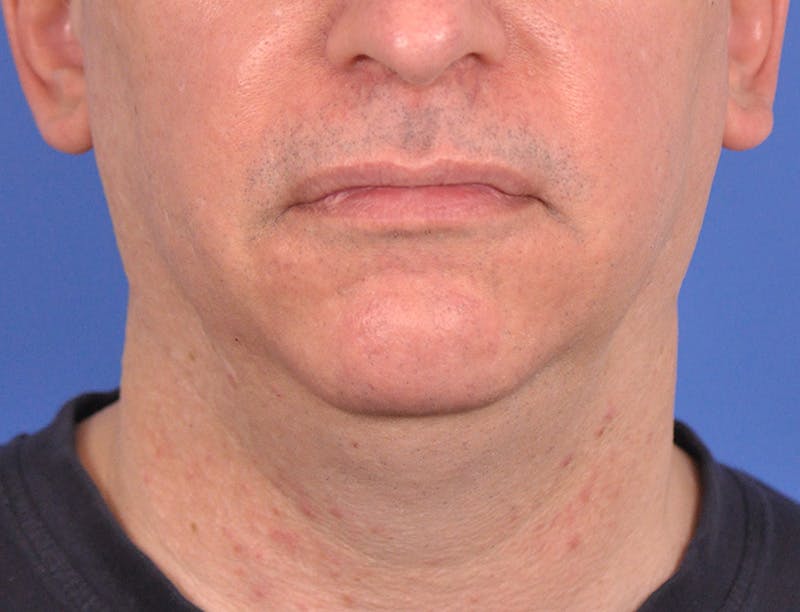 Neck Lift Before & After Gallery - Patient 180861992 - Image 5