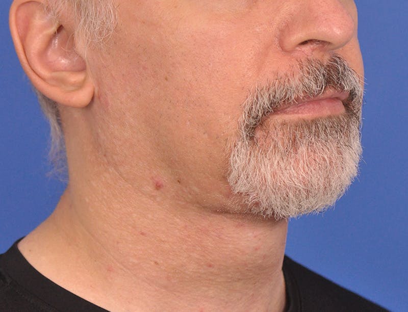 Neck Lift Before & After Gallery - Patient 180861992 - Image 4