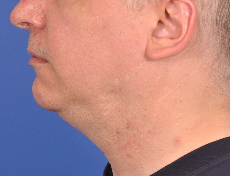 Neck Lift Before & After Gallery - Patient 180861992 - Image 9