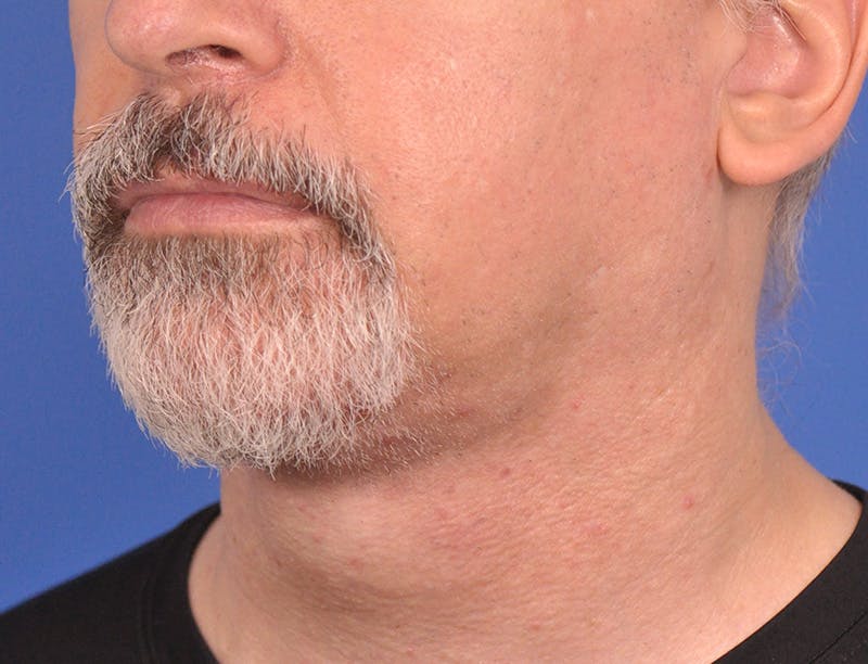 Neck Lift Before & After Gallery - Patient 180861992 - Image 8
