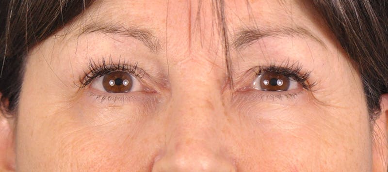 Brow Lift Before & After Gallery - Patient 180861999 - Image 1