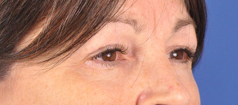 Brow Lift Before & After Gallery - Patient 180861999 - Image 3