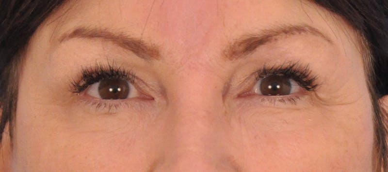 Brow Lift Before & After Gallery - Patient 180861999 - Image 2