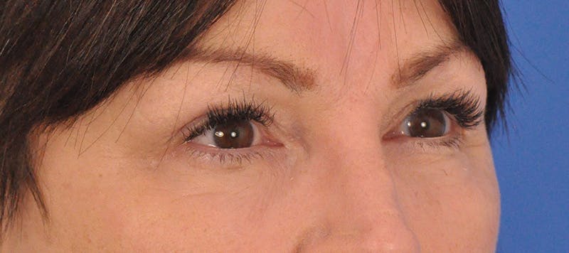 Brow Lift Before & After Gallery - Patient 180861999 - Image 4
