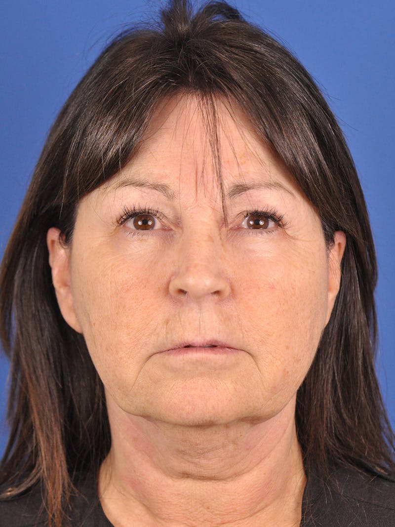 Facelift Before & After Gallery - Patient 180862017 - Image 1