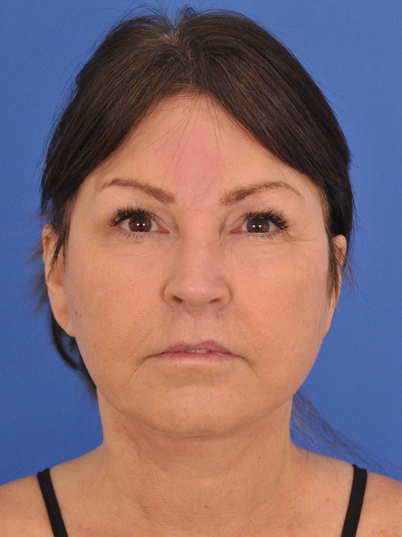 Facelift Before & After Gallery - Patient 180862017 - Image 2