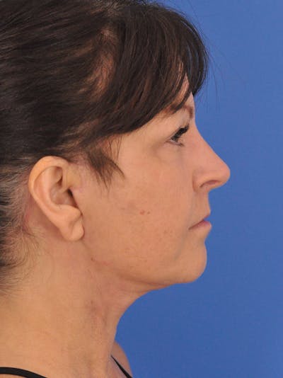 Neck Lift Before & After Gallery - Patient 180862018 - Image 2