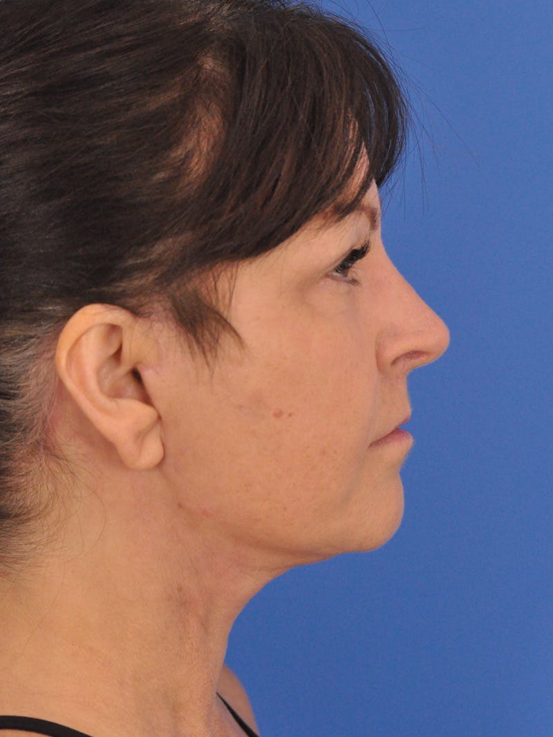 Facelift Before & After Gallery - Patient 180862017 - Image 6