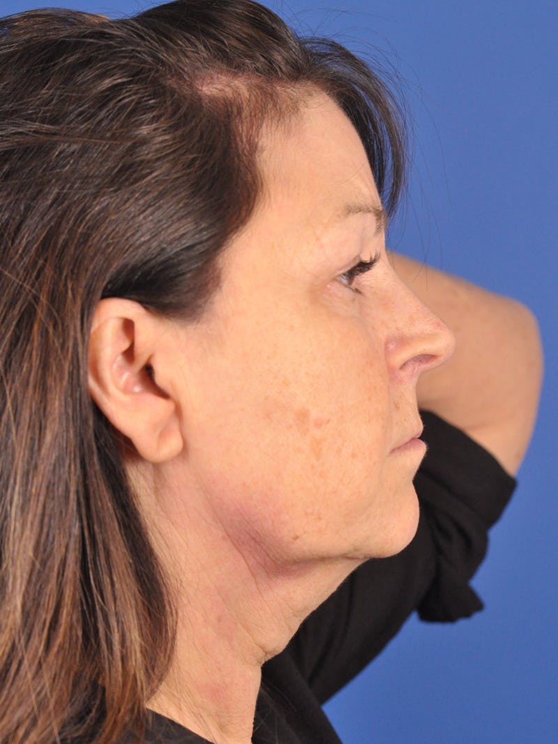 Facelift Before & After Gallery - Patient 180862017 - Image 5
