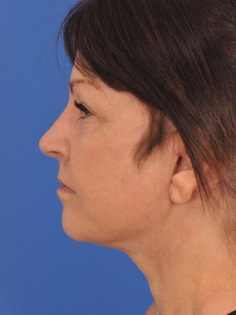 Neck Lift Before & After Gallery - Patient 180862018 - Image 10