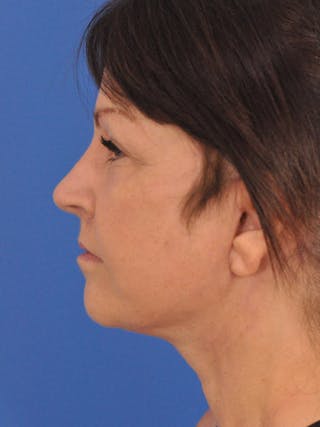 Facelift Before & After Gallery - Patient 180862017 - Image 10
