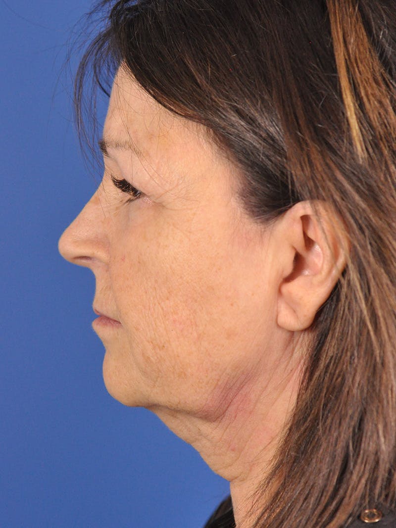Neck Lift Before & After Gallery - Patient 180862018 - Image 9