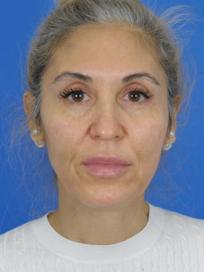 Facelift Before & After Gallery - Patient 180862777 - Image 1